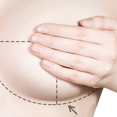 Cirurgia Oncoplástica: O tratamento refinado do câncer de mama.
