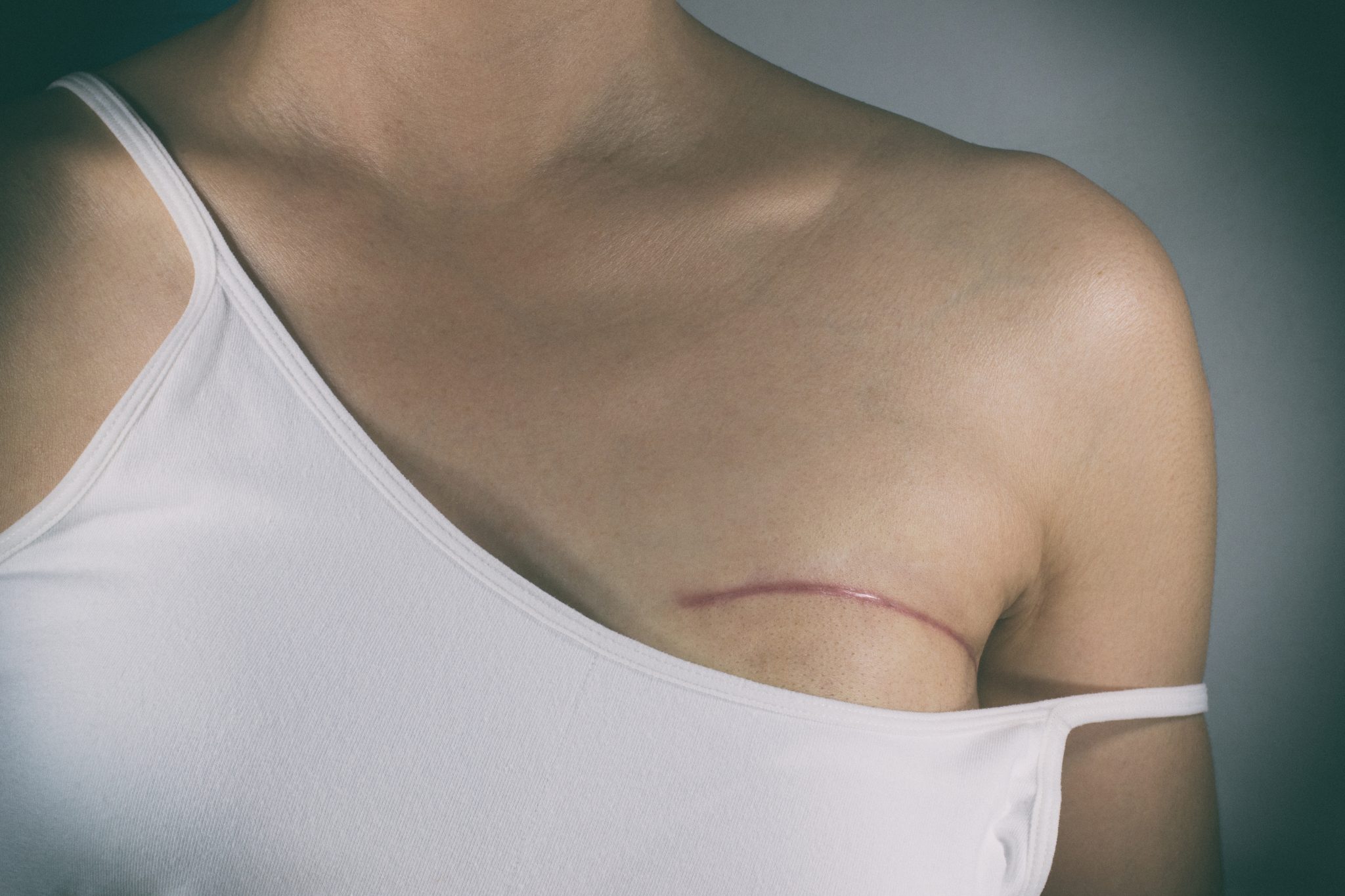 Mastectomia: Tot ce trebuie să știi despre această procedură