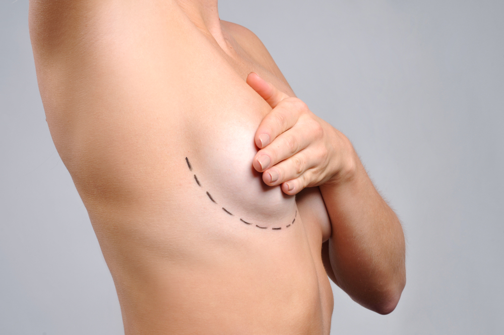 Conheça as opções para reconstrução mamária após a mastectomia