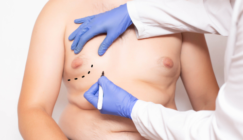 O pré e pós-operatório da cirurgia de ginecomastia